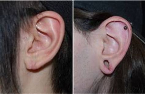 Hey, hipsters: New surgery can reverse stretched-out ear lobes