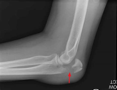 Olecranon fracture causes, symptoms, diagnosis, treatment & prognosis