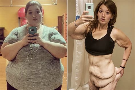 Woman who lost 312 pounds is removing 7 pounds of loose skin