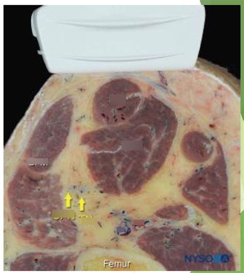 Popliteal Sciatic Block anatomy Diagram | Quizlet