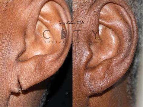 NYC Ear Lobe Repair Before and After Pictures | New York | UES