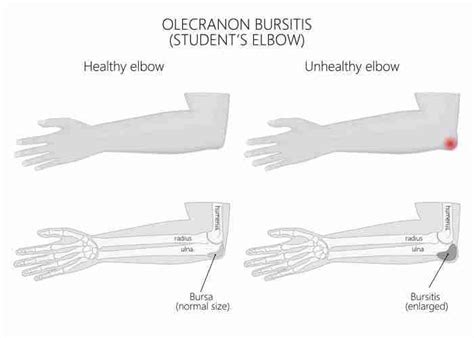 Injections for Olecranon Bursitis | Steroid Injections For Elbow Pain | Olecranon Bursitis ...