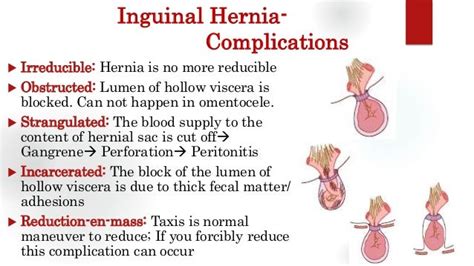 Inguinal Hernia- Groin Swellings