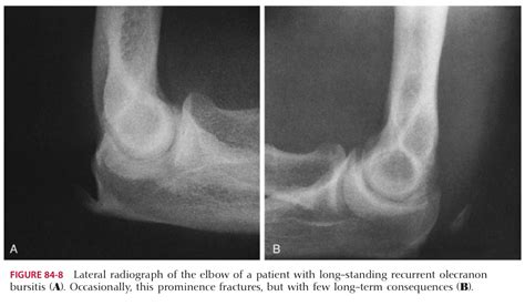 Olecranon Bursitis - General Components and Differential Diagnosis of the Elbow