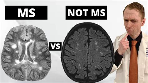 MS MRI Lesions Benign White Matter Lesions Explained By, 51% OFF