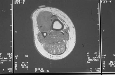 Synovial Sarcoma: Soft Tissue Sarcoma