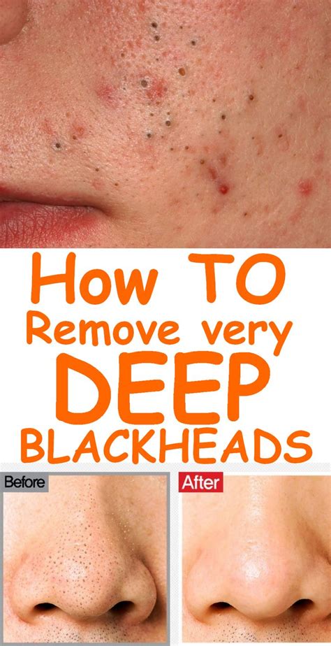 How Are Blackheads Formed - Blackheads Removal | New Pimple Popping Videos / But if it doesn't ...