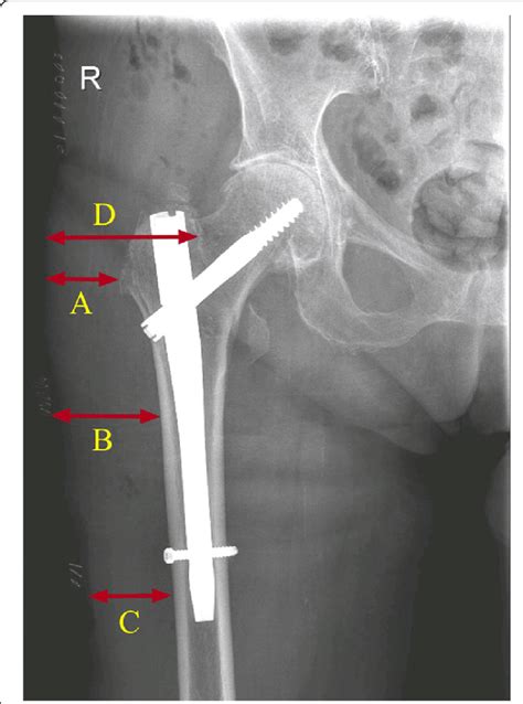 Trochanteric Femoral Nail