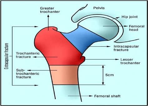 Subcapital Left Femoral Neck Fracture