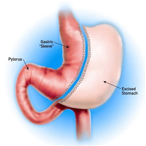 Gastric Sleeve Surgery Complications and How to Minimize It