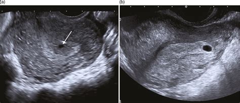 Pregnancy 5 Weeks 3 Days Ultrasound - PregnancyWalls