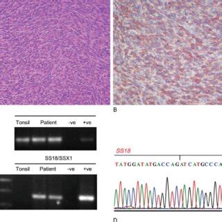 Histologic and molecular features of synovial sarcoma. A, A monophasic... | Download Scientific ...