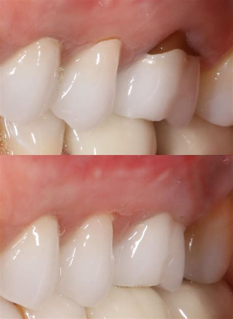 Fix receding gums graft repair | Boynton Beach Gum Specialist | Periodontist Delray Beach ...