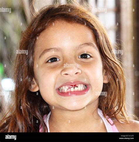 Little girl who is missing her 2 front teeth Stock Photo, Royalty Free Image: 310425477 - Alamy