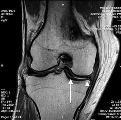 RACGP - MRI of the knee