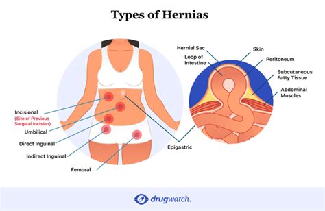 How Do You Know If You Have Hernia Mesh Complications