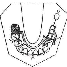 Mandibular framework design: I-bar clasp on 21 provides direct... | Download Scientific Diagram