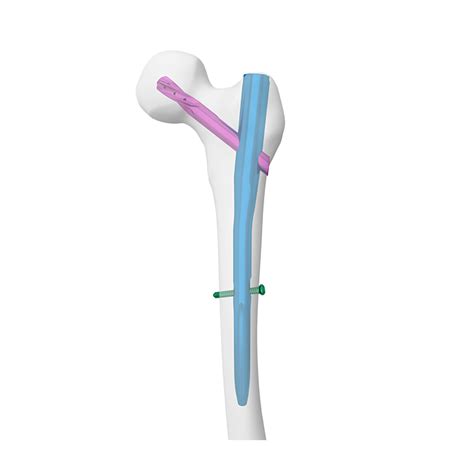 APFN Aimstrong Proximal Femoral Nail,Medical Device Manufacturers -Double Medical