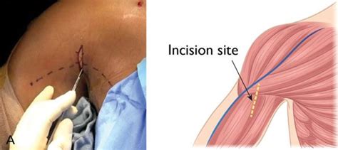 Biceps Tendon Injuries: How to Treat: Colorado Sports Medicine & Orthopaedics: Orthopaedics