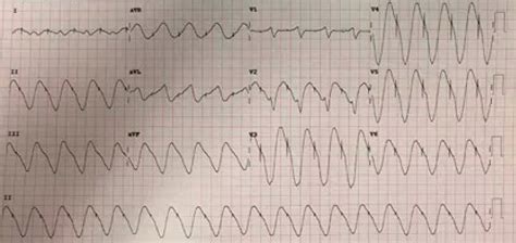 Dr. Smith's ECG Blog: Weakness and Dyspnea with a Sine Wave. It's not what you think!