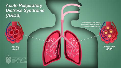 Acute respiratory arrest