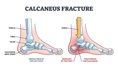 Calcaneus Fracture: Symptoms & Treatment by a Foot Specialist