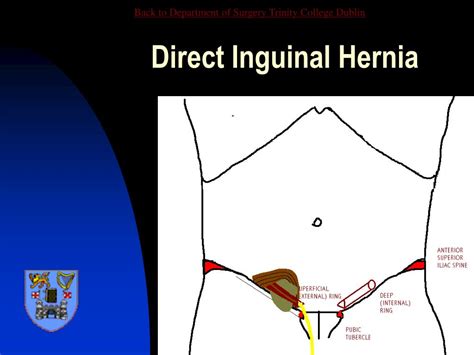 Abdominal Hernia Anatomy