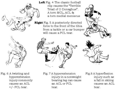 welterxoif - torn acl exercises