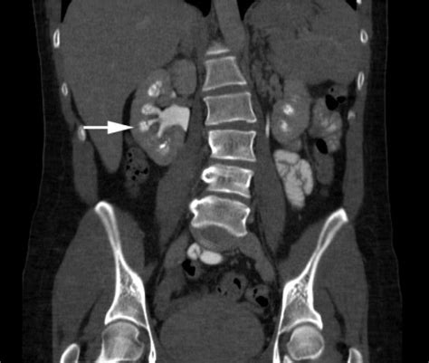 Image Diagnosis: Medullary Sponge Kidney | The Permanente Journal