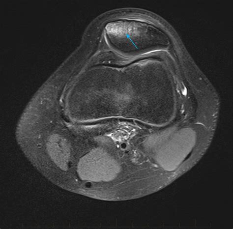 8-paediatric-mri-scan-knee-patella-fracture - MRI at Melbourne Radiology Clinic