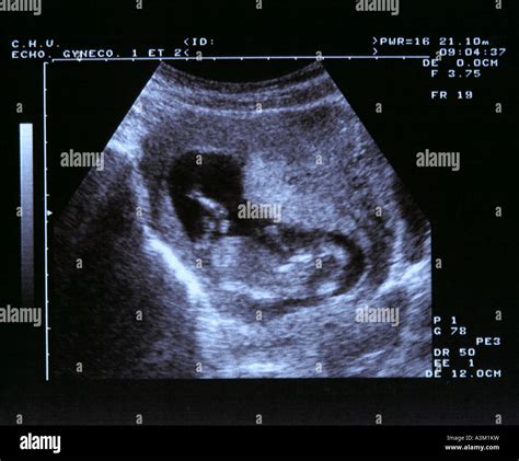 Ultrasound Scan One Month Stock Image Of Pregnancy 5922863, 44% OFF