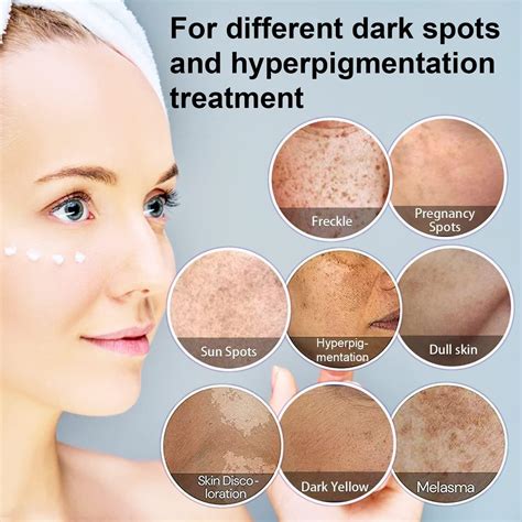 Dark Spot Remover for Face | Hyperpigmentation & Melasma Treatment | Corrector for All Skin Types