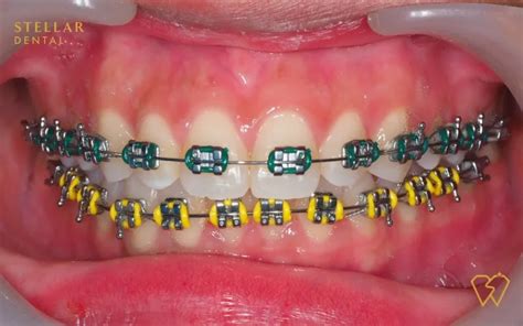 Braces Colors: Top Picks For 2023 - Stellar Dental