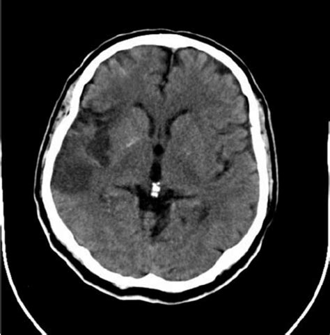 schemic stroke in parietal lobe (computed tomography) in a patient with... | Download Scientific ...