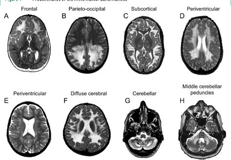 Figure 1 from An MRI-based approach to the diagnosis of white matter disorders | Semantic Scholar