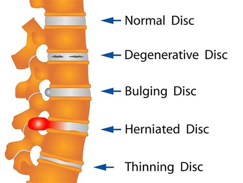 Bulging Disc | Novus Spine & Pain in Lakeland, Florida