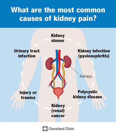 Kidney Pain: Causes, Treatment & When To Call A Doctor