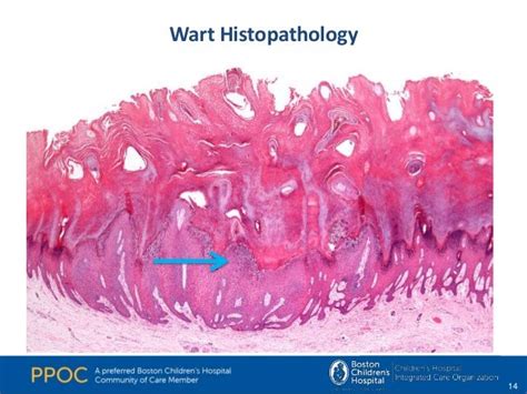 [DIAGRAM] Diagram Of Elbow Wart - MYDIAGRAM.ONLINE