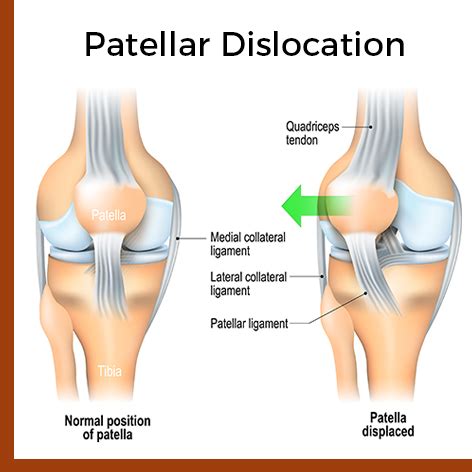 Patellafemoral Pain Syndrome - Davidson Orthopedics