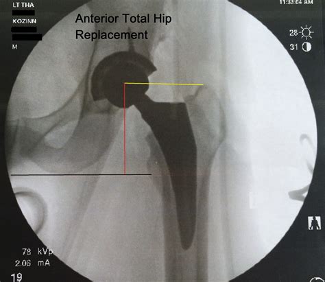 Anterior Hip Replacement Recovery Timeline | Renew Physical Therapy