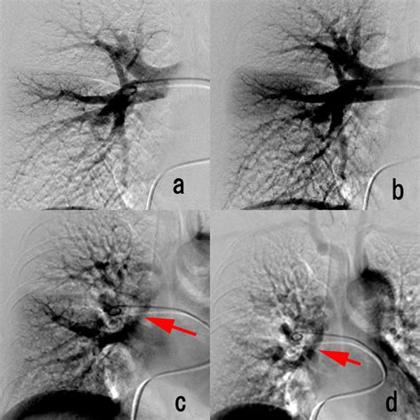 -Pulmonary angiography. Pulmonary angiography with the catheter tip on... | Download Scientific ...