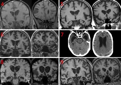 Brain Scans of Dementia Patients with Coprophagia Showed Neurodegeneration - Neuroscience News