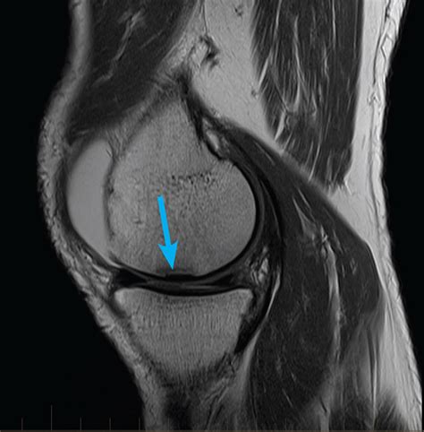 mri-knee-meniscus-tear - MRI at Melbourne Radiology Clinic