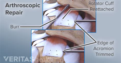 Rotator Cuff Tendon Tear Grades