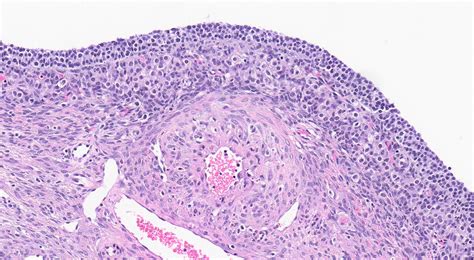 Ovarian Follicle Cyst