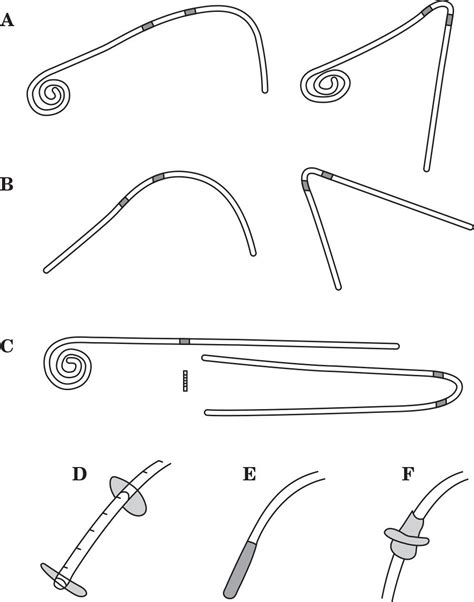 Peritoneal Dialysis Catheters, Placement, and Care | Abdominal Key