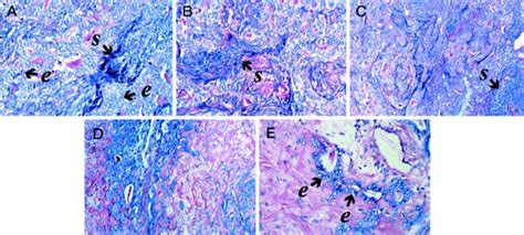 Histomorphological features of the synovial sarcoma (SS)-I considered... | Download Scientific ...