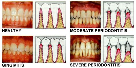 What Causes Receding Gums?