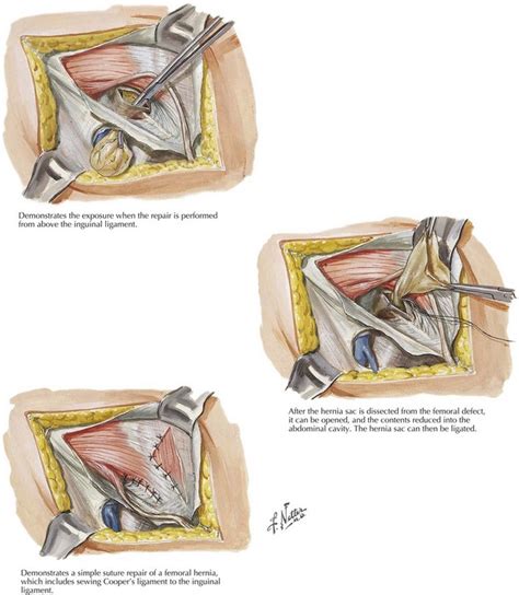 Femoral Hernia Repair | Basicmedical Key