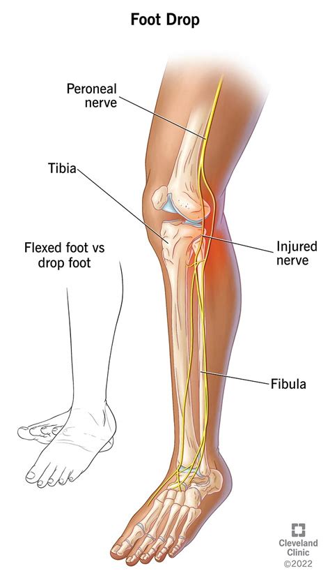 Peroneal Nerve Entrapment Knee | SexiezPicz Web Porn